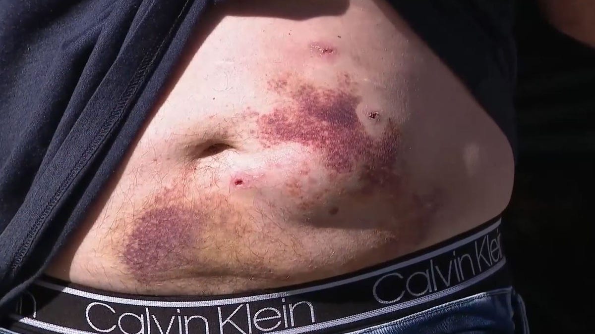 A mark from a bear bite to the stomach.