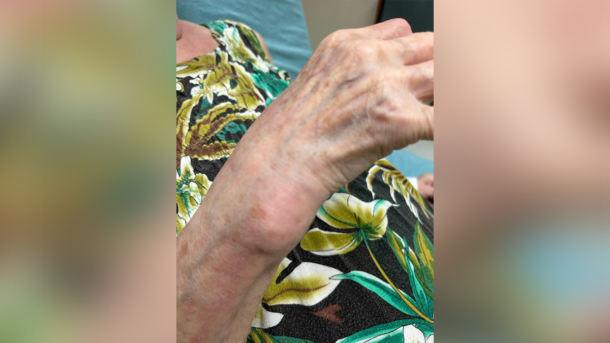 83-year-old woman's wrist