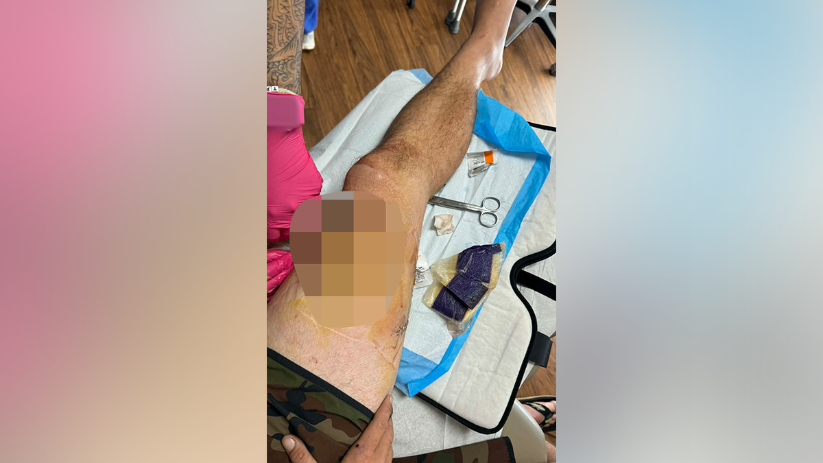 Stitches after shark bite