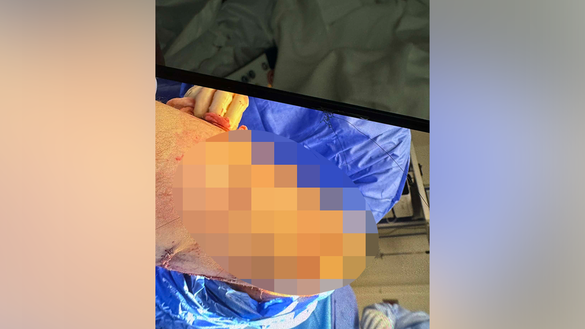 Stitched up fisherman's leg