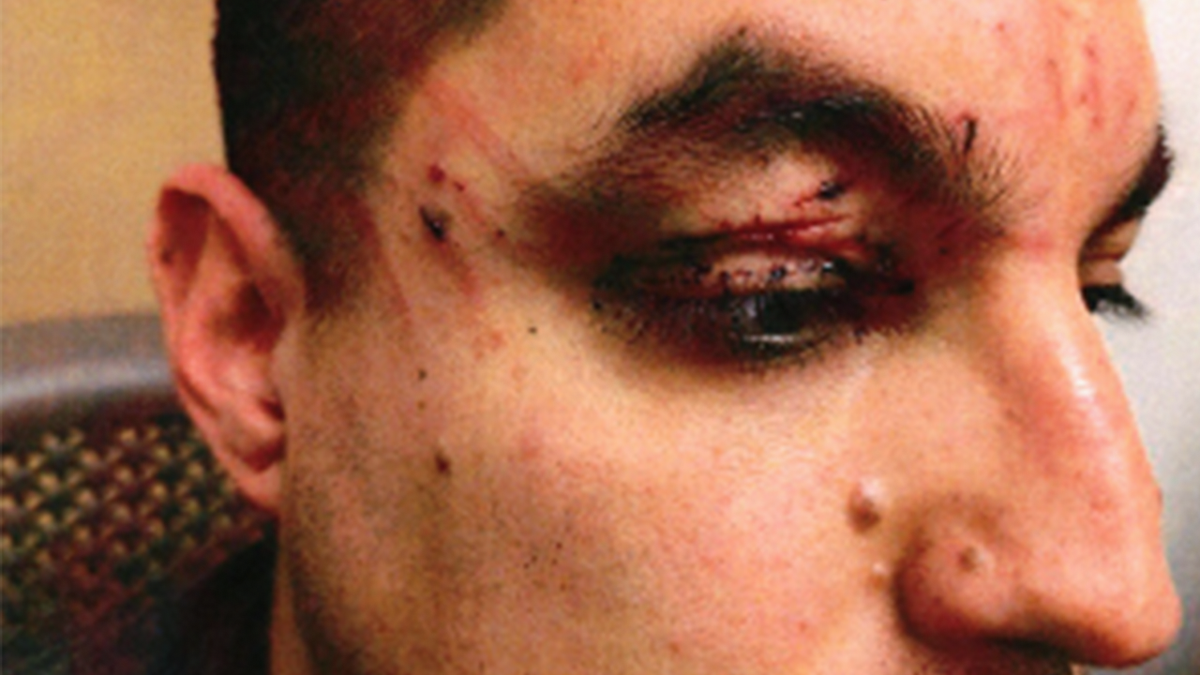 Victim eye injury after flight attack.